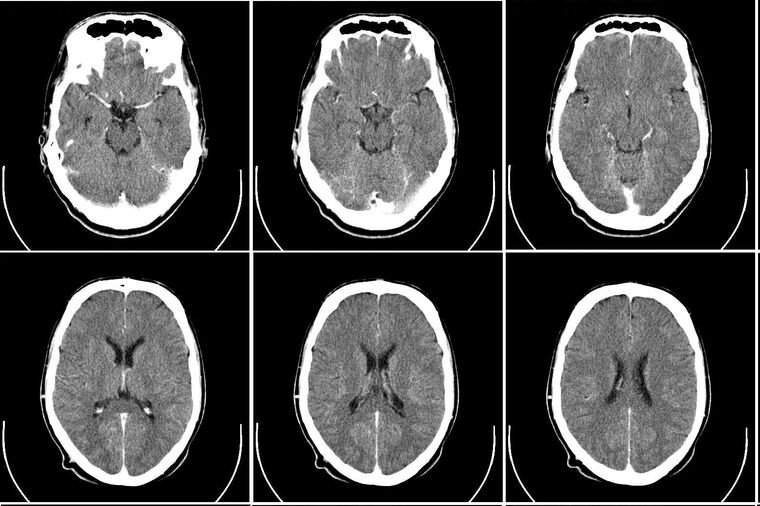 CT scan images of a human brain